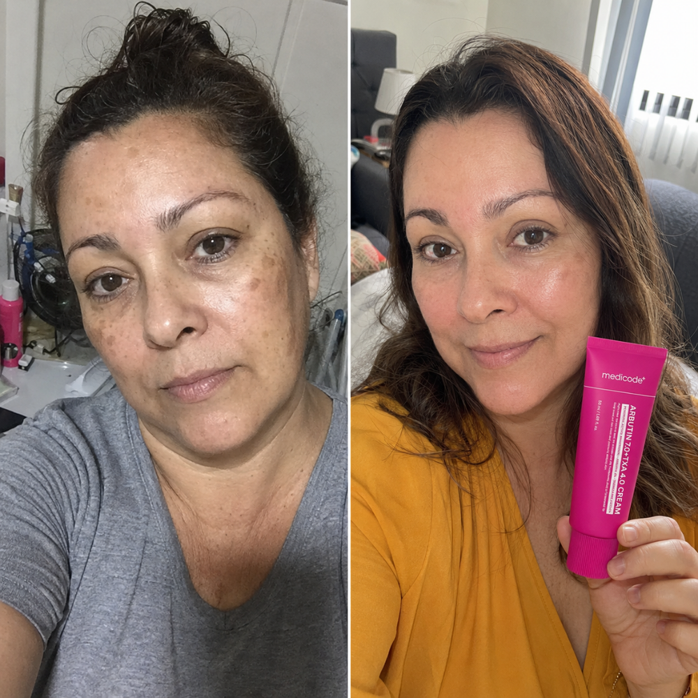 arbutin tranexamic acid cream, look of skin tone before and after