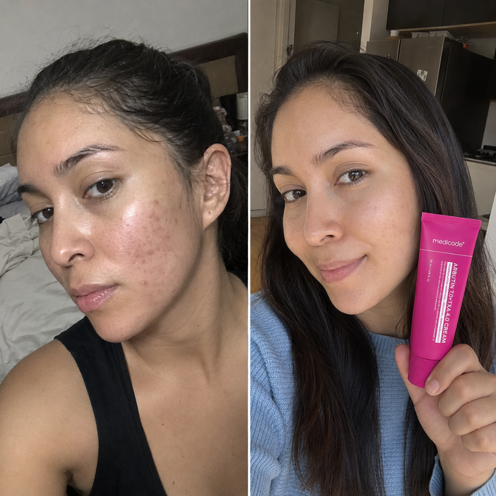 arbutin tranexamic acid cream, look of skin tone before and after