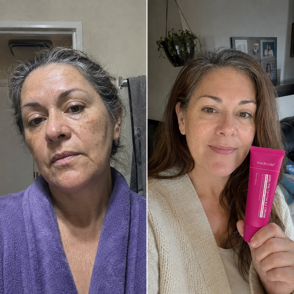arbutin tranexamic acid cream, look of skin tone before and after