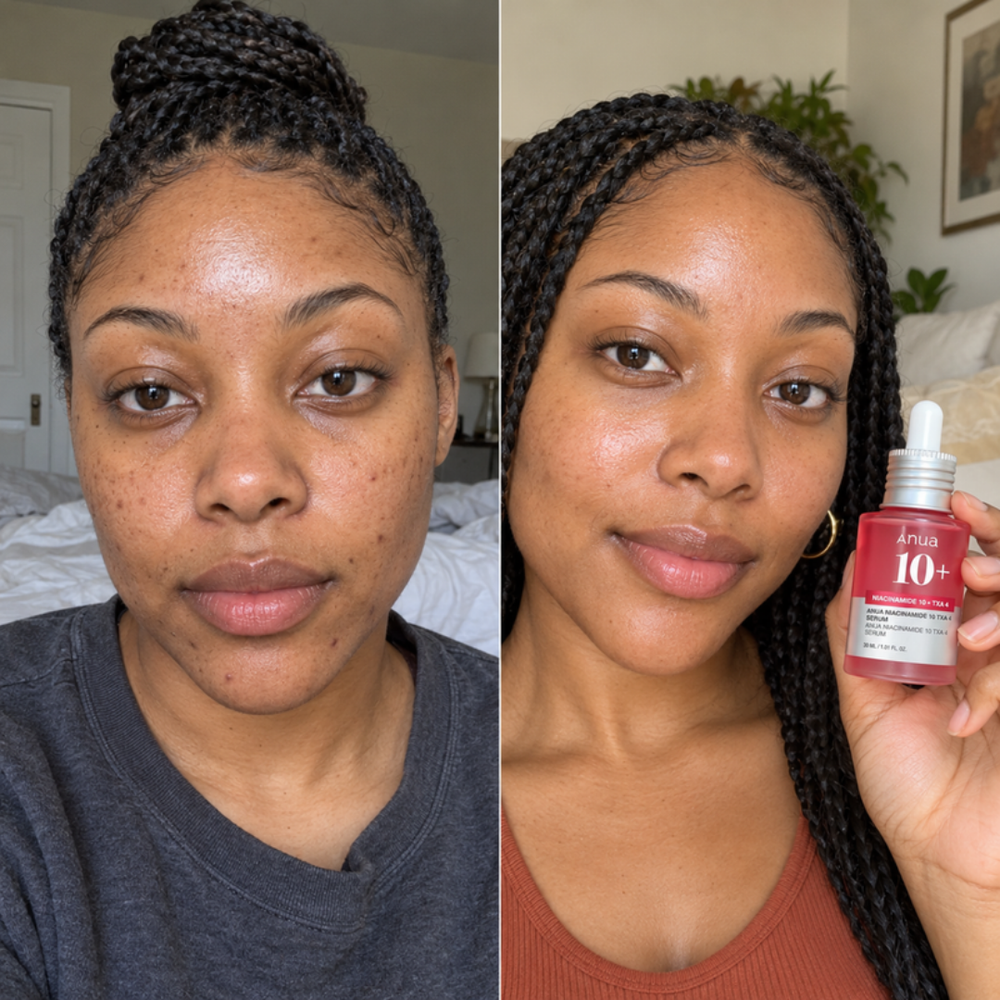Anua Niacinamide 10+ Serum, look of post-blemish marks bare and after daily use