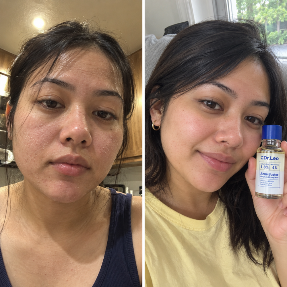 Dr.Leo drying lotion, the look of one spot before and the next morning