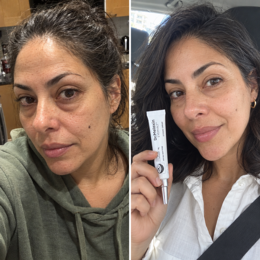Dr.Melaxin Eyephalt Eyebag Cream, under-eye area before and after 1 use